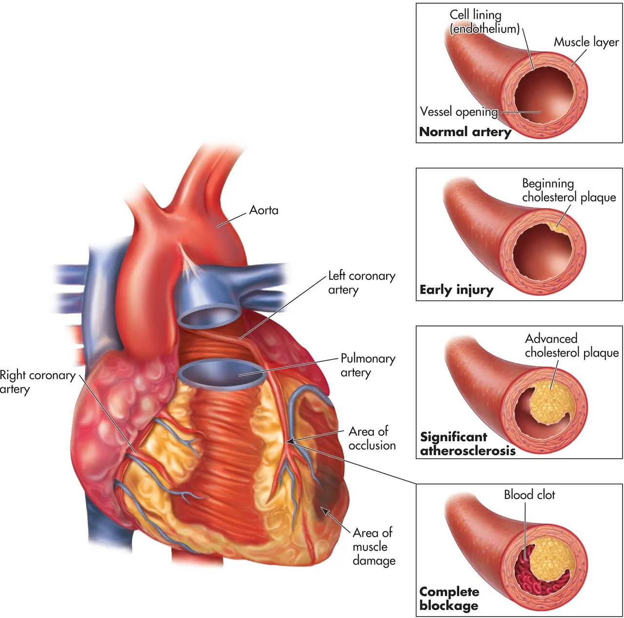 Myocardial infarction