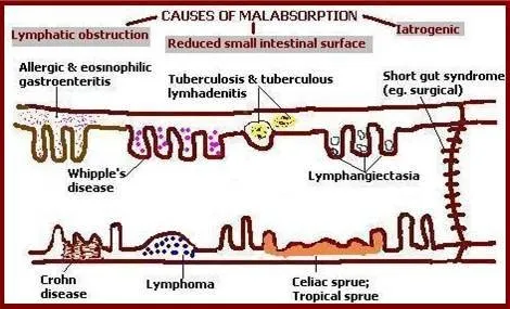 malabsorption treatment