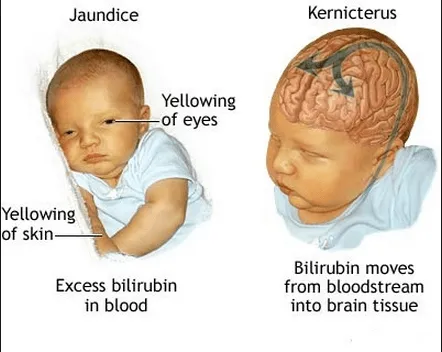 neonatal jaundice