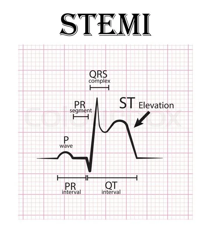 ST elevation MI