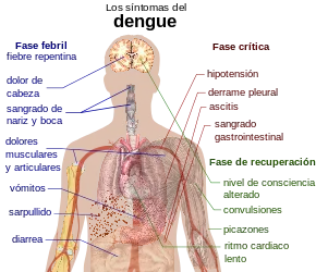 Dengue_fever_symptoms_es.svg.png