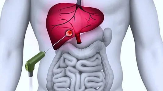 Ablation Technologies Market.jpg