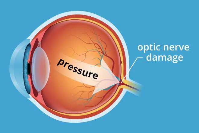 glaucoma-pressure-330x220@2x.jpg