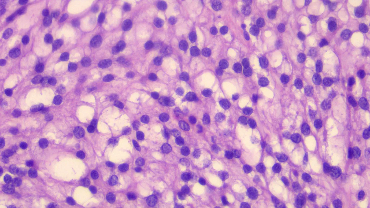 Microcystic Stromal Tumor HPF 3.png