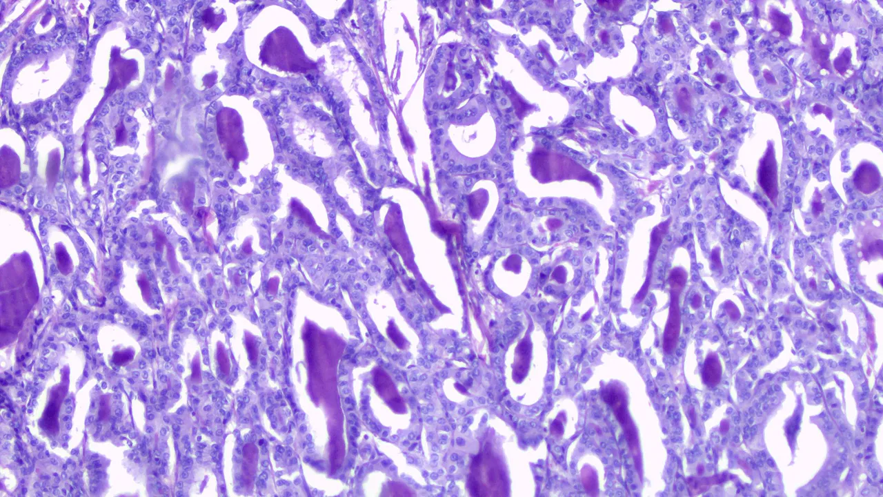 Papillary Thyroid Carcinoma LPF.png