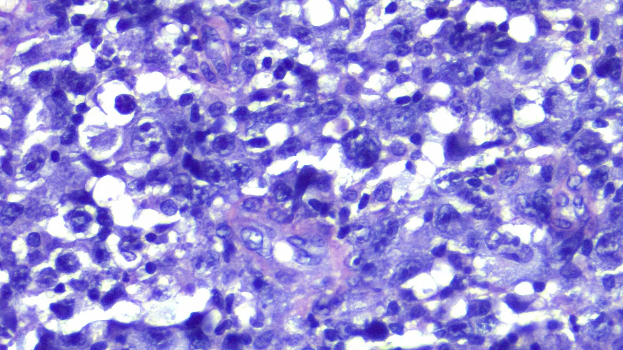 Anaplastic Large Cell Lymphoma HPF3.png