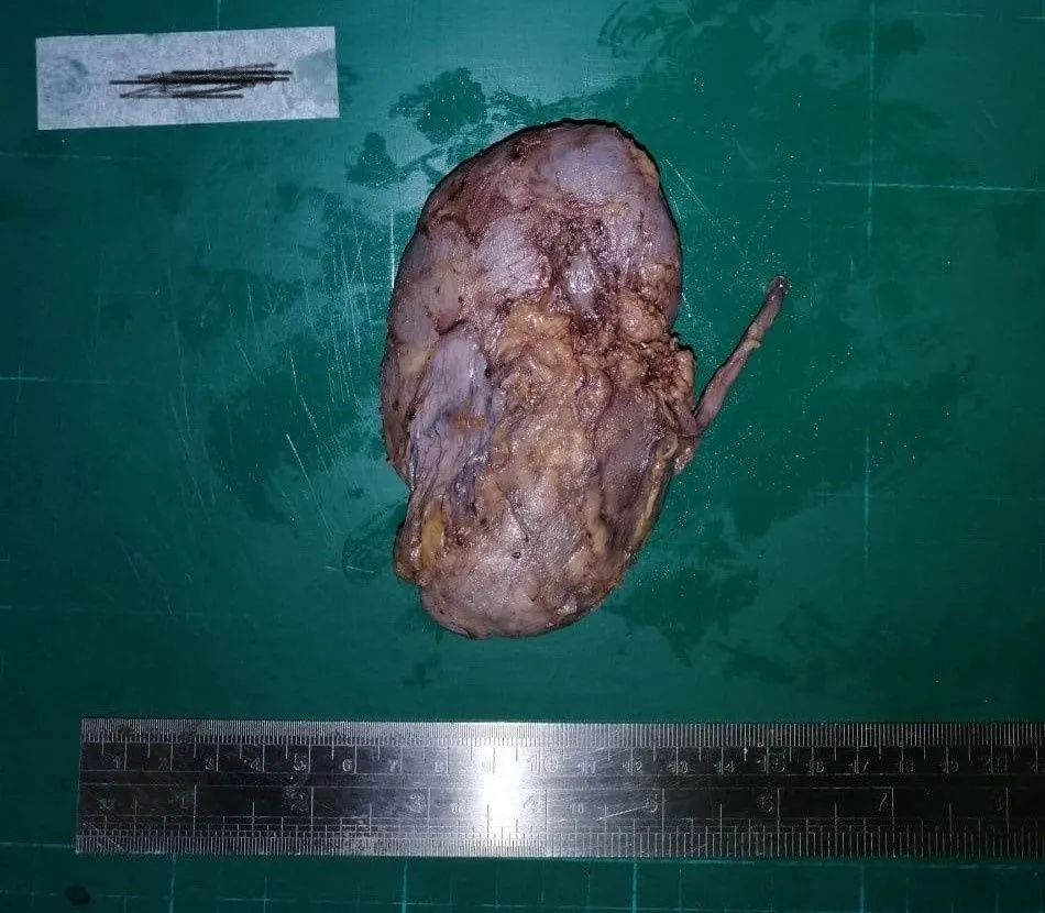 InkedAnterior view stem 2_LI.jpg