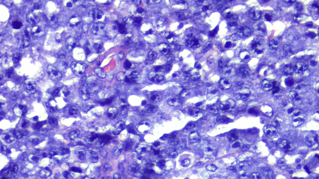 Anaplastic Large Cell Lymphoma HPF2.png