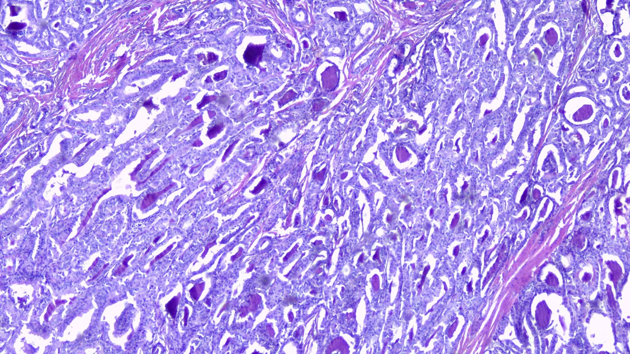 Papillary Thyroid Carcinoma Scan.png