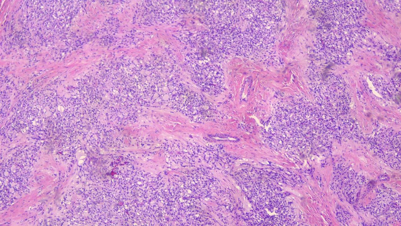 Microcystic Stromal Tumor Scanner 1.png