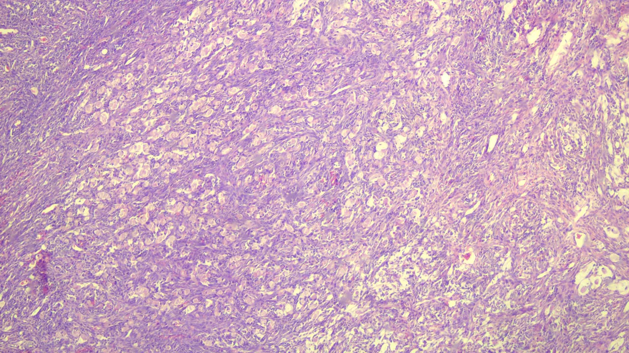Krukenberg Tumor Ovary Scanner.png