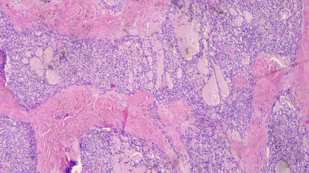 Microcystic Stromal Tumor Scanner 3.png