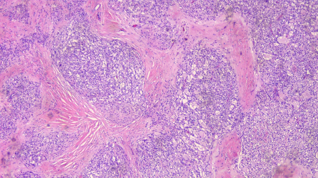 Microcystic Stromal Tumor Scanner 2.png