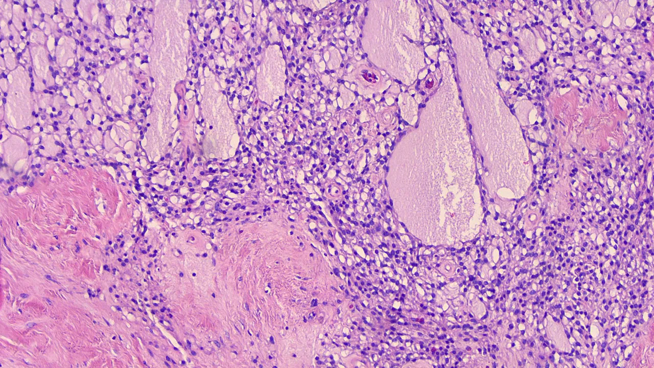 Microcystic Stromal Tumor LPF 1.png