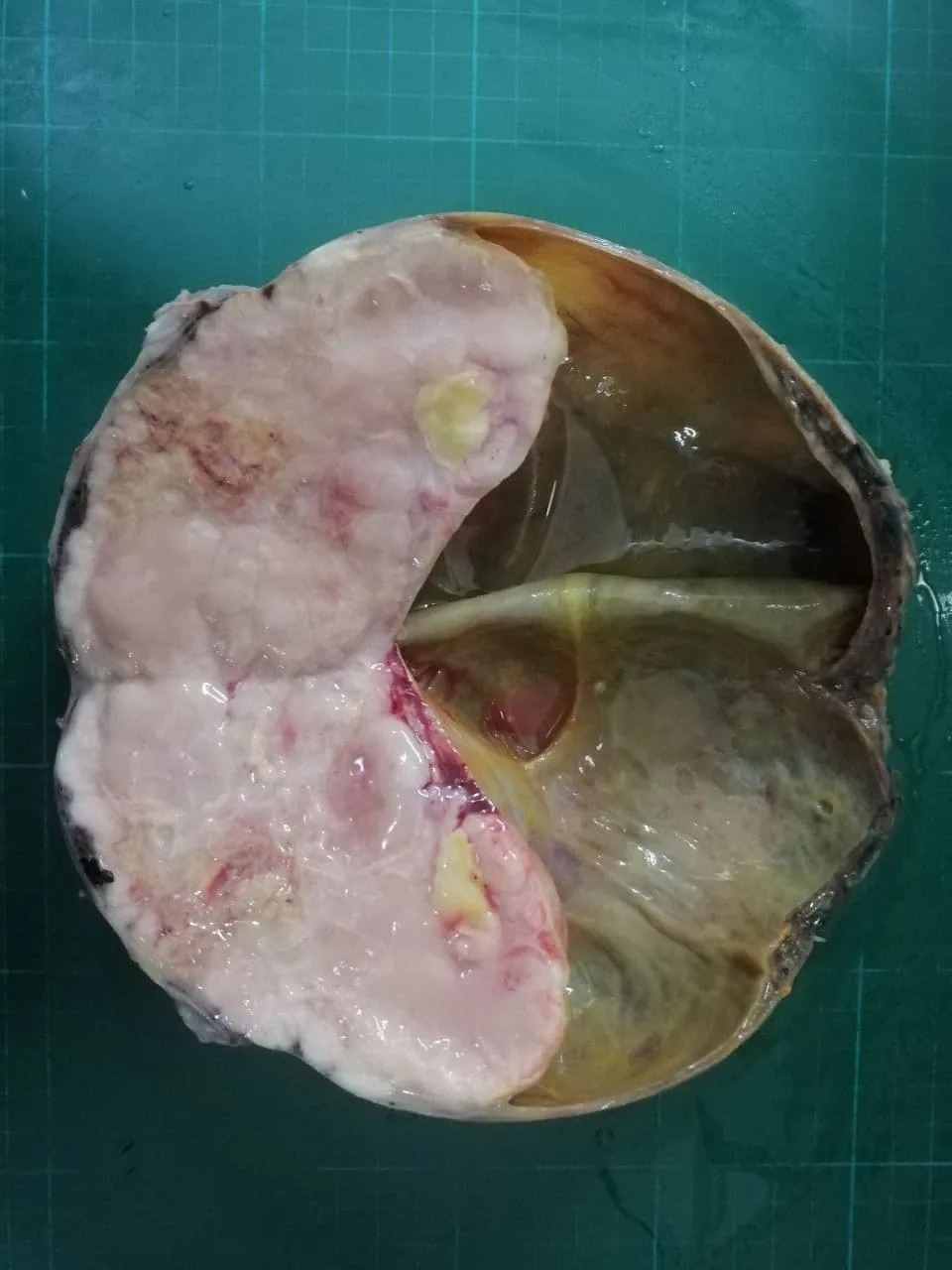Mature Cystic Teratoma.jpg
