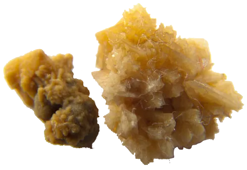 Kidney-Stones.png