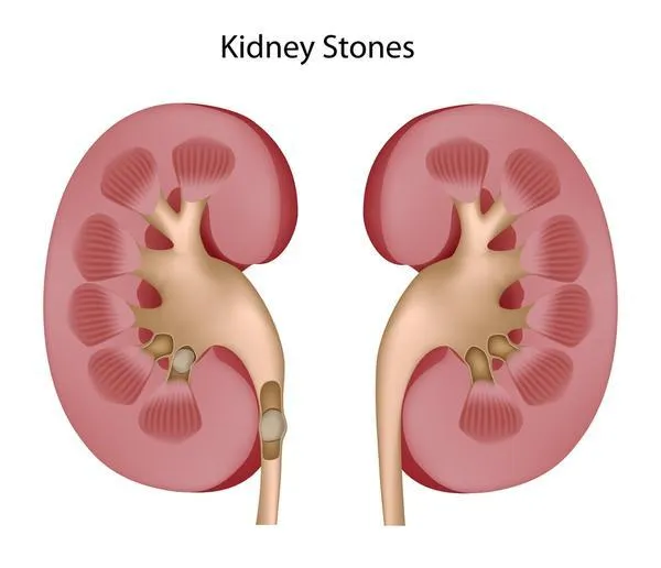 kidney_stone.jpeg