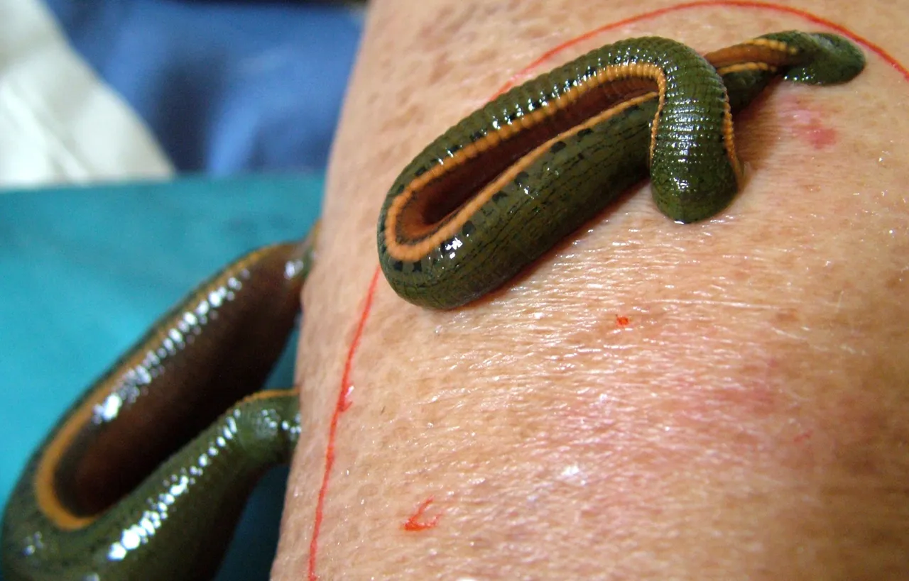 leech-therapy.jpg