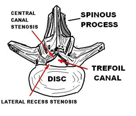 LUMBAR_TREFOIL_CANAL.JPG