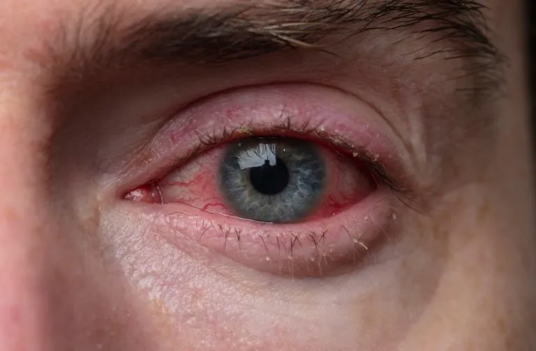 man-with-pink-eye-768x504.jpg