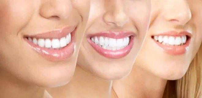 tooth-whitening(bleaching).jpg