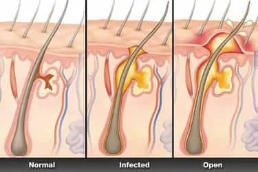 webmd_rf_photo_of_boils_illustration.jpg