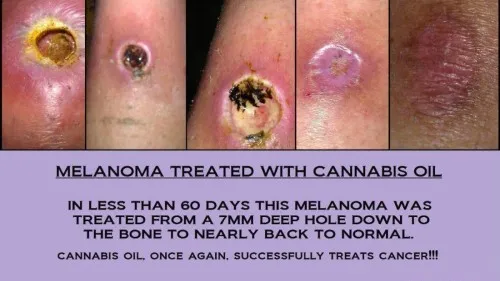 How_To_Make_Cannabis_Oil_25-500x281.jpg