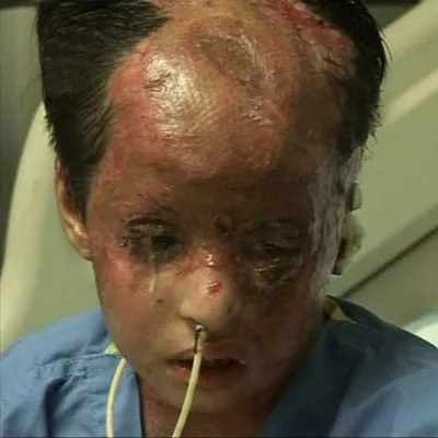 white_phosphorus_victim_afghanistan.jpg