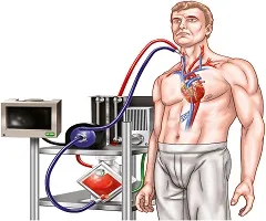 Intravenous Membrane Oxygenator.jpg