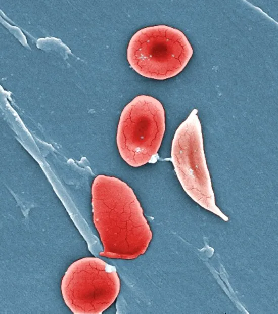 https://pixnio.com/science/microscopy-images/patient-with-sickle-cell-anemia-hbss
