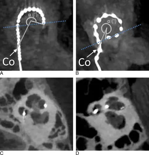Figure-2-Postoperative-cone-beam-CT-of-inserted-Med-EL-Flex28-and-Cochlear-CI422-arrays.png