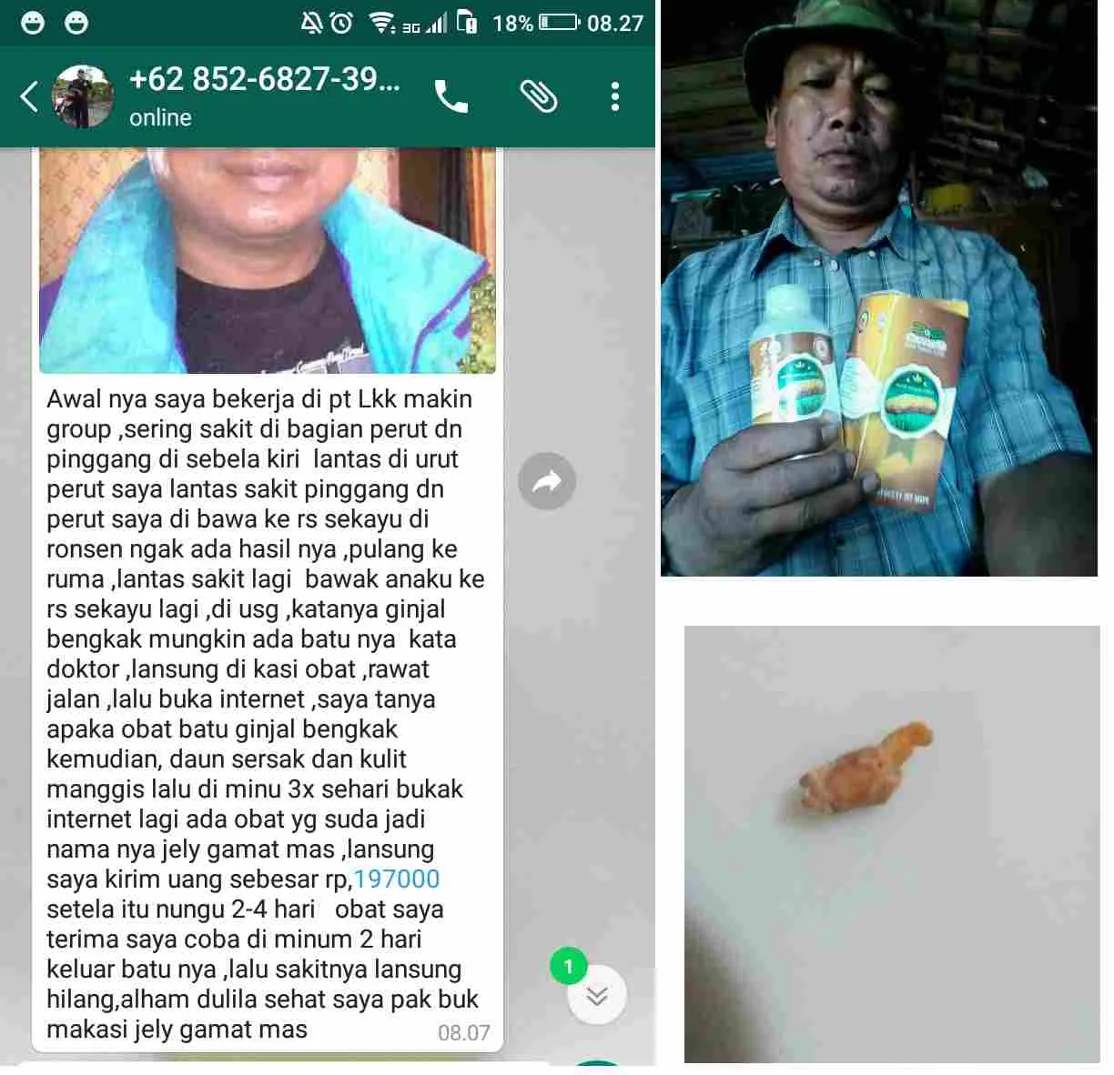 cara-mengobati-batu-ginjal-tanpa-operasi-1.jpg