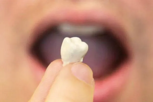 dientes-caidos-reemplazos.jpeg