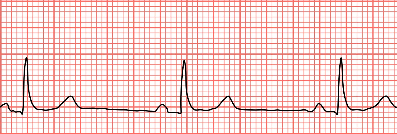 1280px-Sinus_bradycardia_lead2.svg.png