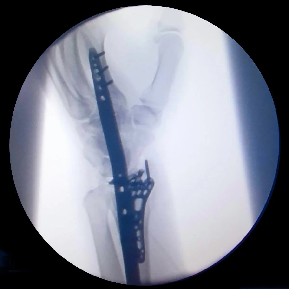 Left Wrist X-Ray