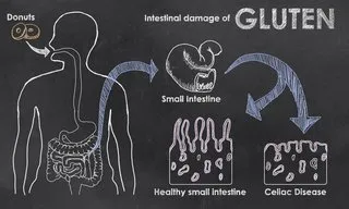 bigstock-intestinal-damage-of-gluten-56636603