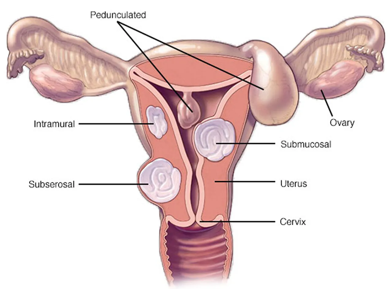 the-muscular-wall-of-the-uterus-uterine-fibroids-causes-symptoms-diagnosis-treatment-pregnancy.jpg
