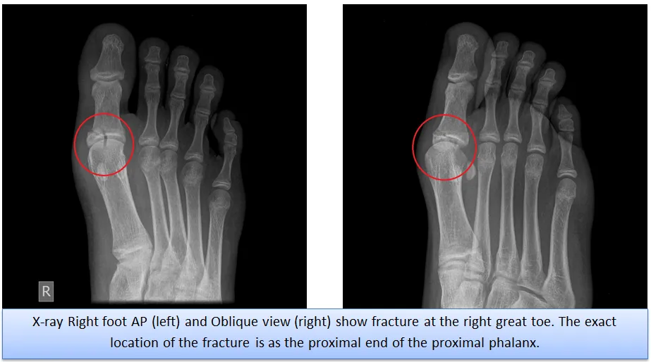 x_ray_right_foot.png