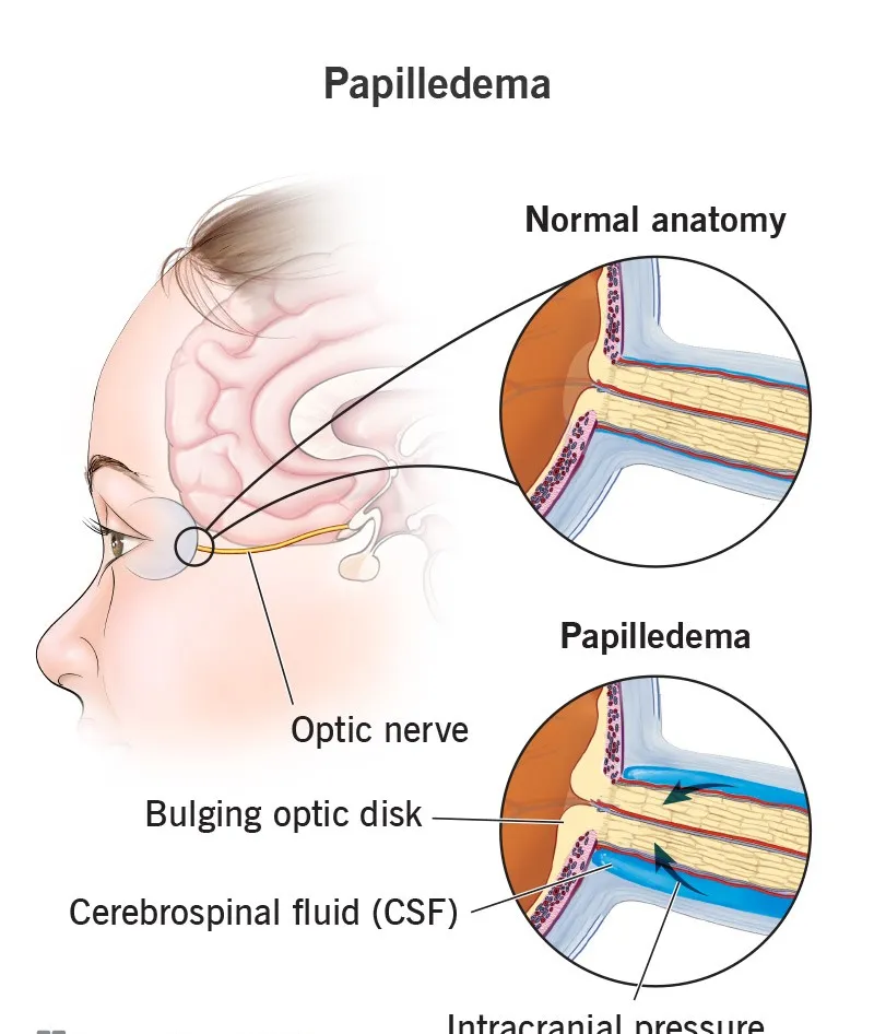 24445-papilledema.jpg