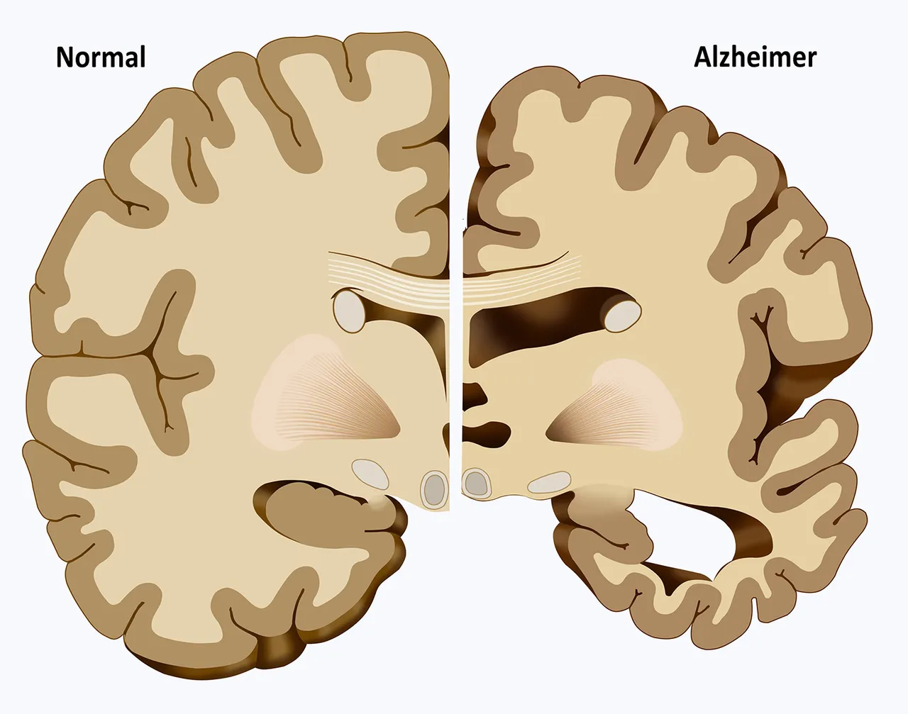 Alzheimers-III-1.jpg