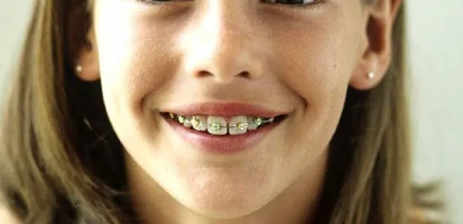 Braces