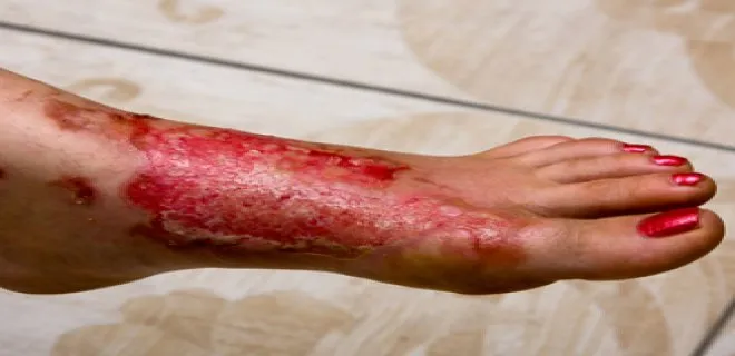 pemphigus is a disease.png
