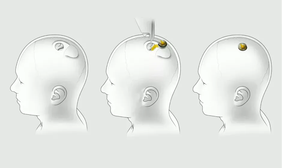 neuralink-installation.webp