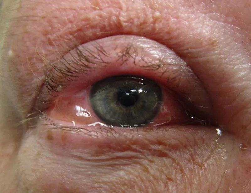 800px-Allergicconjunctivitis.jpg