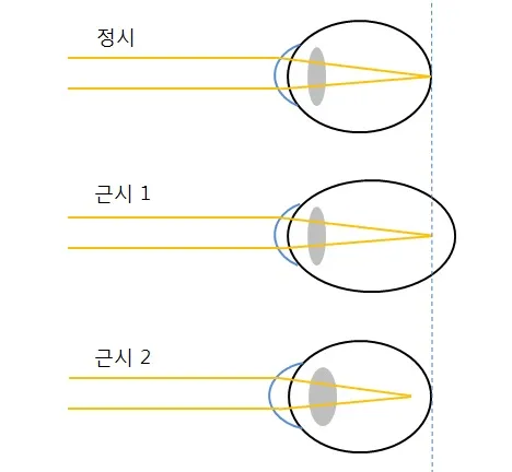 myopia 종류.jpg