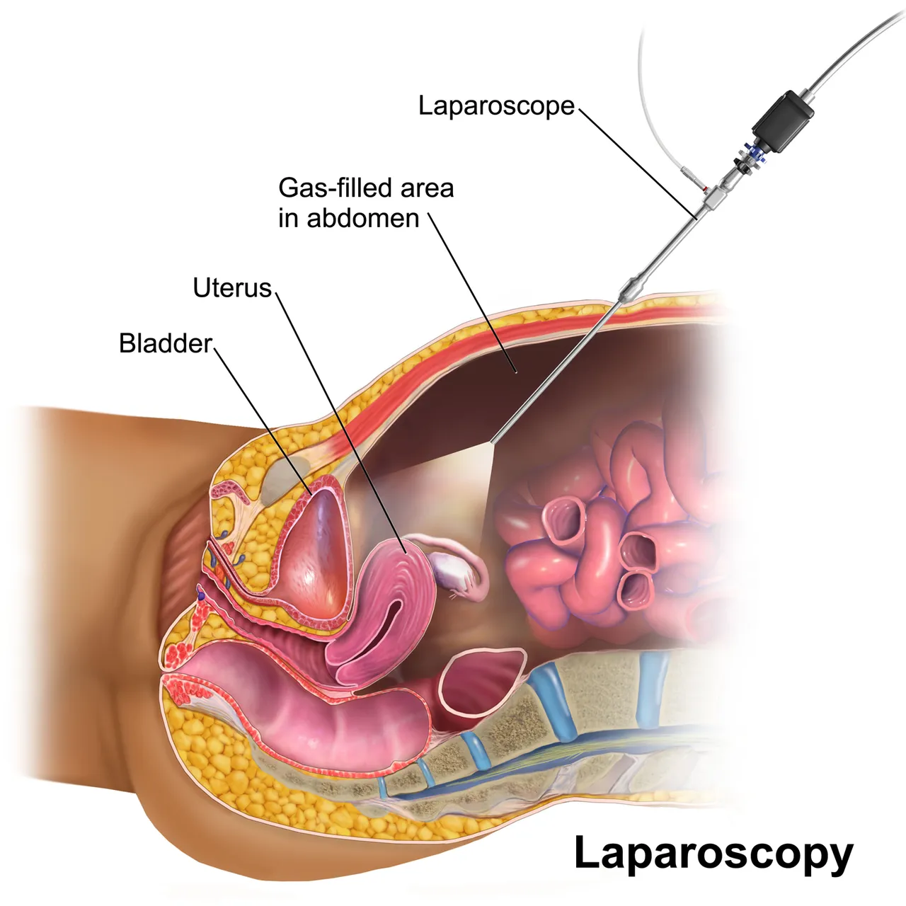 Blausen_0602_Laparoscopy_02.png