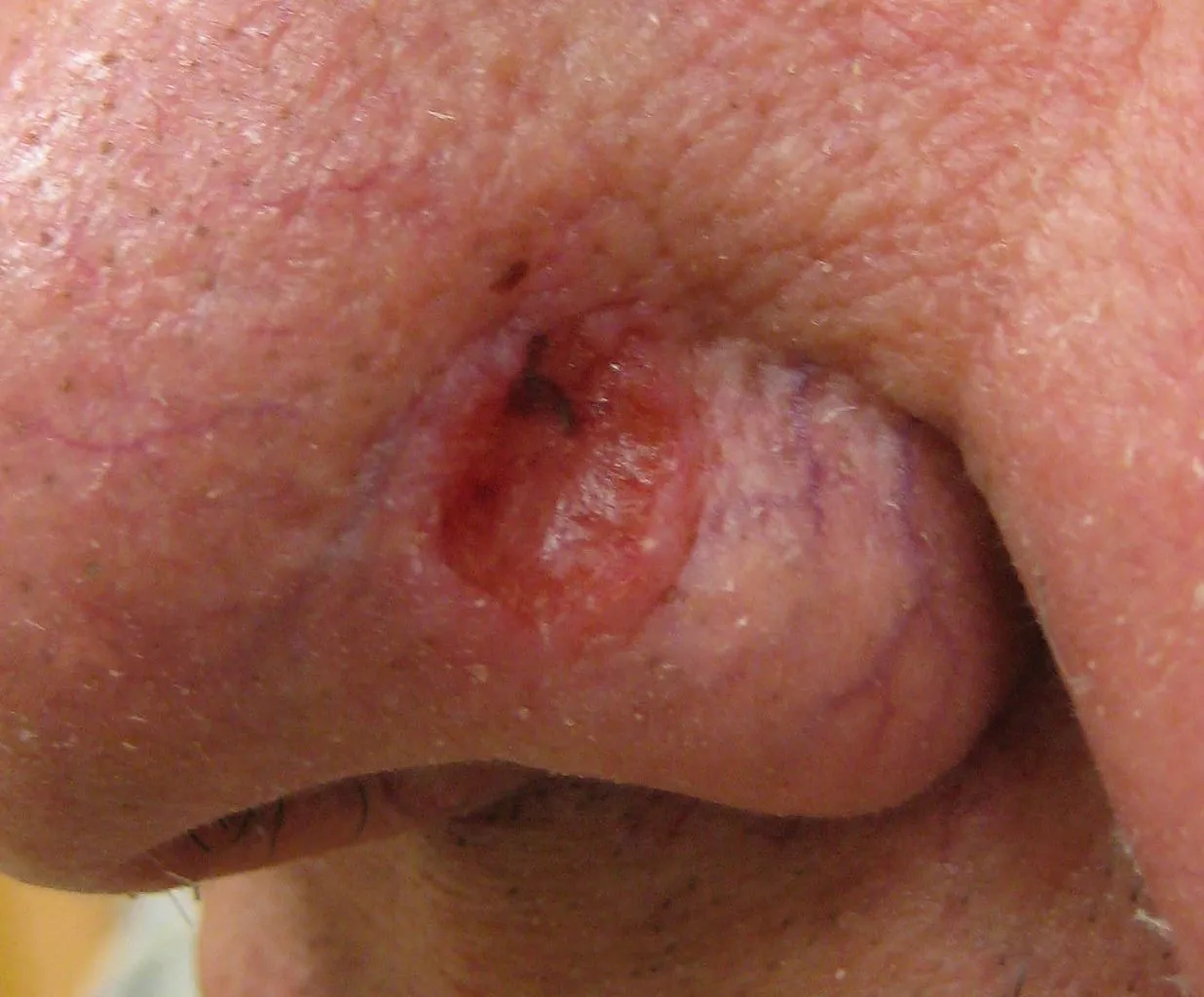 Basal-Cell Carcinoma