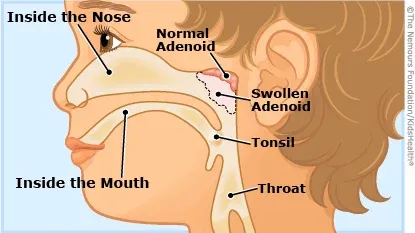 Adenoid hypertrophy in children