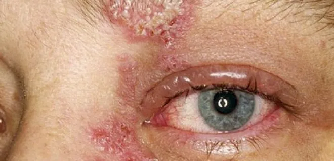 herpes simplex conjunctivitis and the keratit
