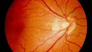 Retinopathy Of Prematurity Therapeutics.jpg